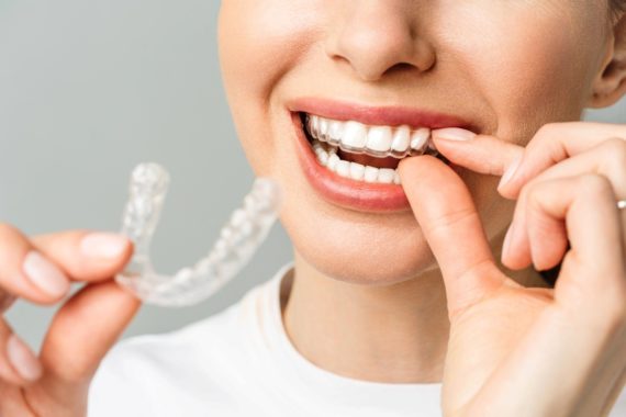 Unsichtbare Zahnspange Invisalign